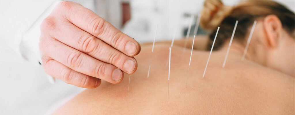 acupunctura